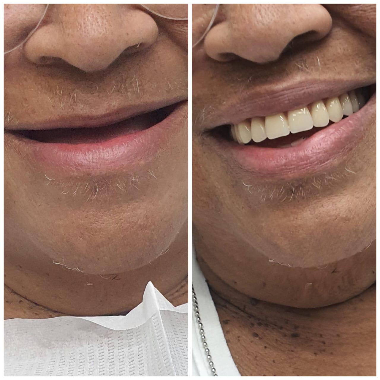 Prótese Dentária