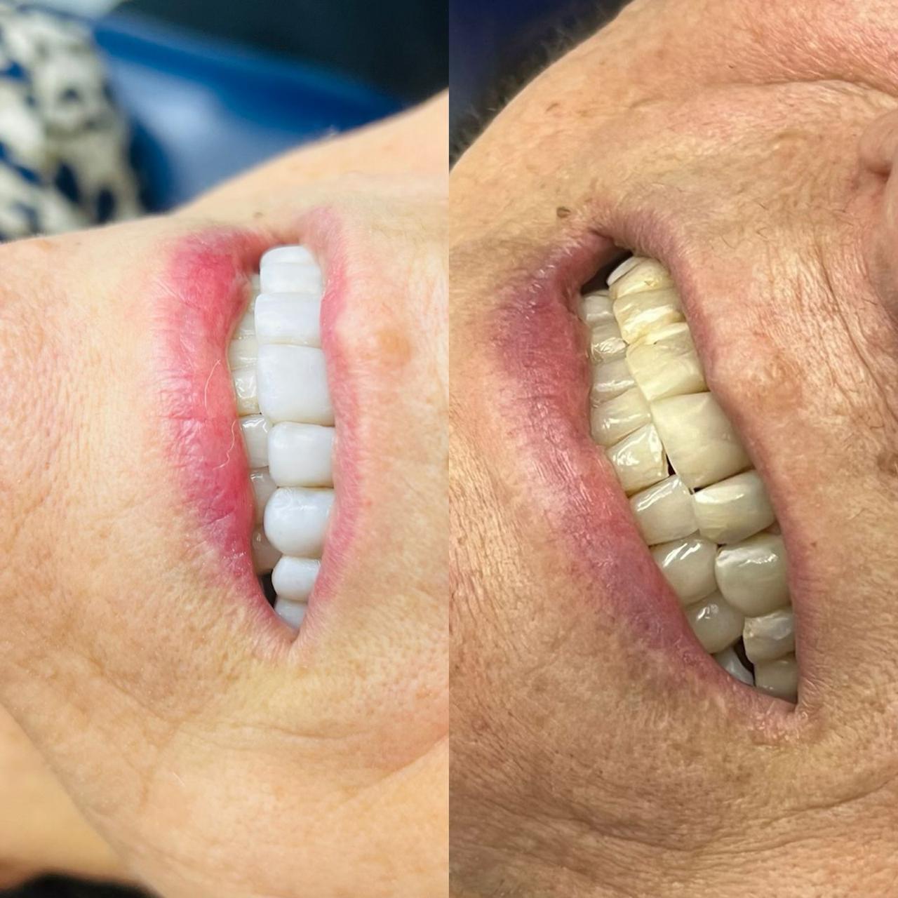 Facetas de Porcelana