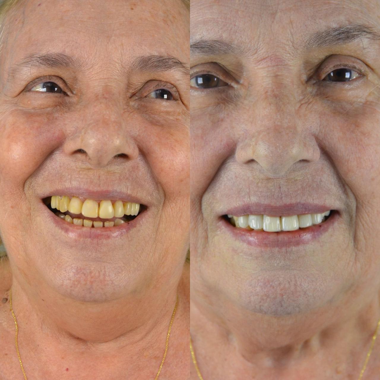 Procedimento de Implante Dentário